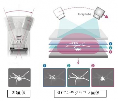 3Dマンモ