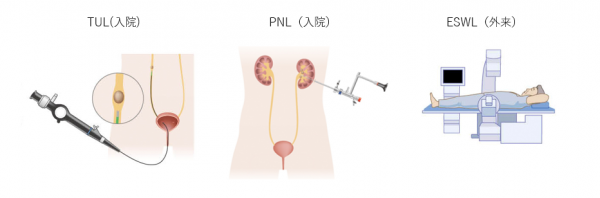 尿路結石治療