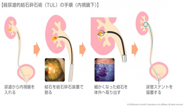 Tul手順