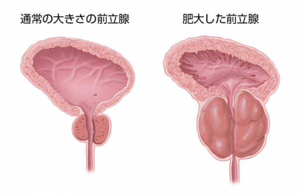 前立腺肥大