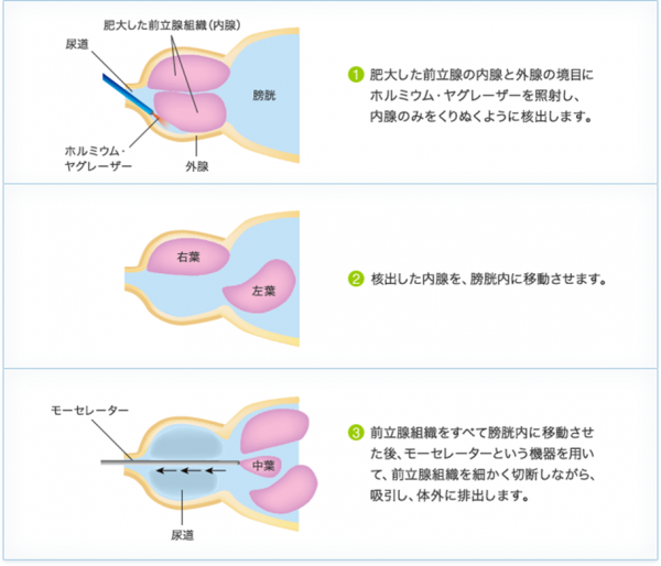 レーザー手順